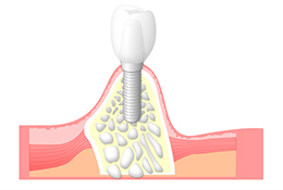 インプラント
